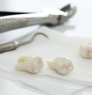 Hvad koster det at få fjernet visdomstænder? Fjernelse af visdomstand